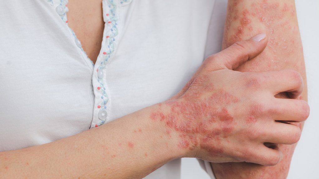 Traitement du Psoriasis par le magnétisme