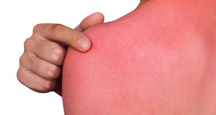 Coupeur de feu pour soulager les coups de soleil